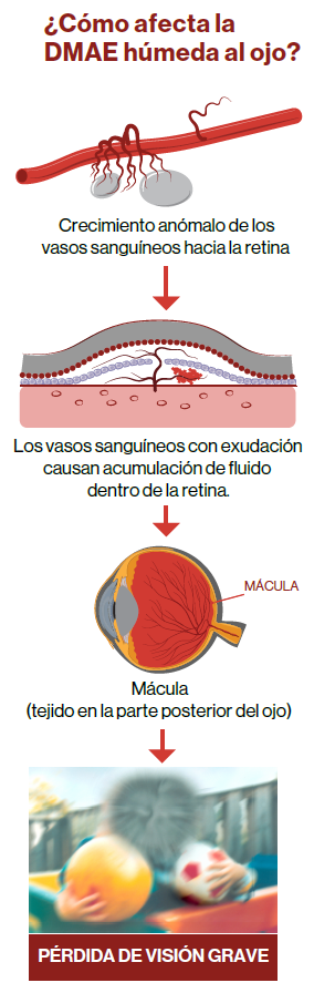 Imagen en la que se explica cómo afecta la DMAE húmeda al ojo. La imagen se divide en 4 fases: En la fase uno, se ve un vaso sanguíneo, y se explica que hay un crecimiento anómalo de los vasos sanguíneos hacia la retina; en la segunda fase, se ve una retina, representando que los vasos sanguíneos con exudación causan acumulación de fluido dentro de la retina; en la tercera fase, aparece una imagen de un ojo, representando la mácula llena de fluido; por último, se ve una imagen que representa la pérdida de visión grave. Esta última imagen simboliza cómo ve un ojo con DMAE.