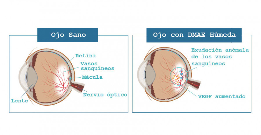 Imagen que compara la diferencia entre un ojo sano y un ojo con DMAE húmeda. El ojo con DMAE húmeda tiene exudación anómala de los vasos sanguíneos.