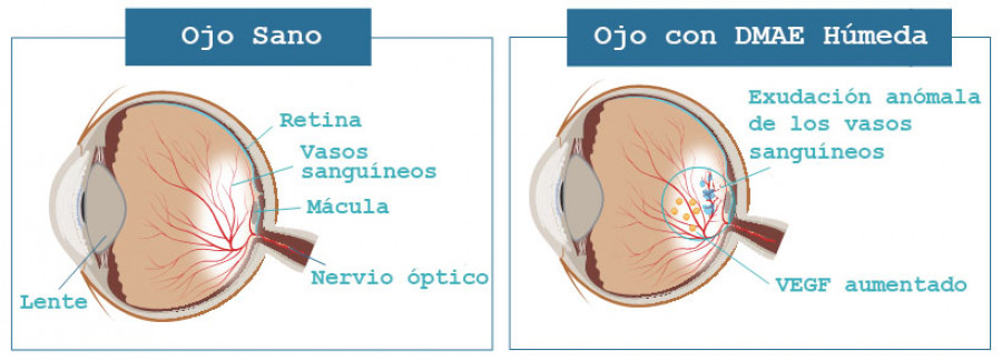 Imagen que compara la diferencia entre un ojo sano y un ojo con DMAE húmeda. El ojo con DMAE húmeda tiene exudación anómala de los vasos sanguíneos.